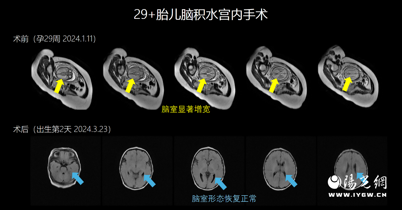 术前、出生后头颅核磁对比