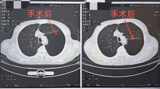 D:/文件/0508呼吸科首例手术/微信图片_20250508120551.jpg微信图片_20250508120551